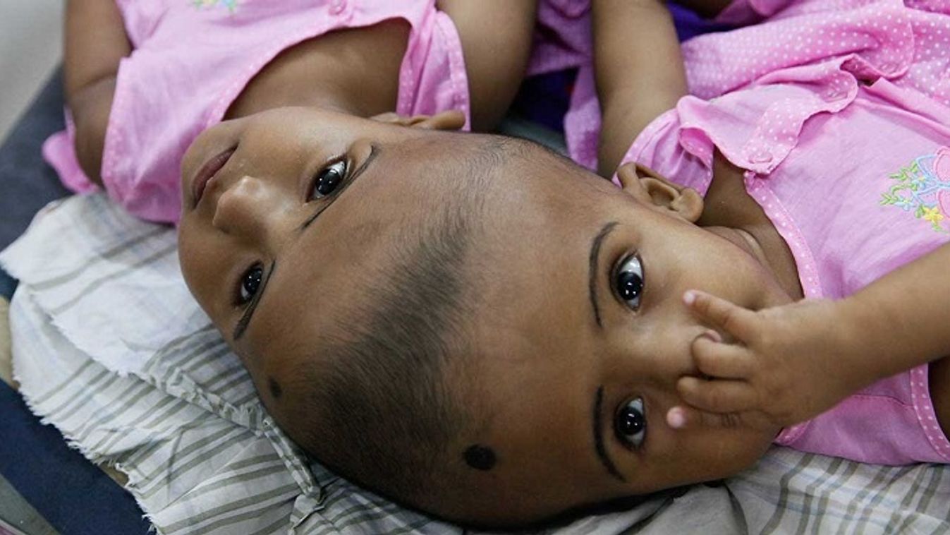 Óriási előrelépést értek el a bangladesi ikrek szétválasztásán dolgozó magyar orvosok