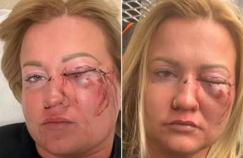 Az áldozat arca a verés után. Ő is fideszesenk állítja be a bántalmazóját, de nem fideszes Bodor András.